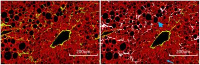 Collagen co-localized with macrovesicular steatosis better differentiates fibrosis progression in non-alcoholic fatty liver disease mouse models
